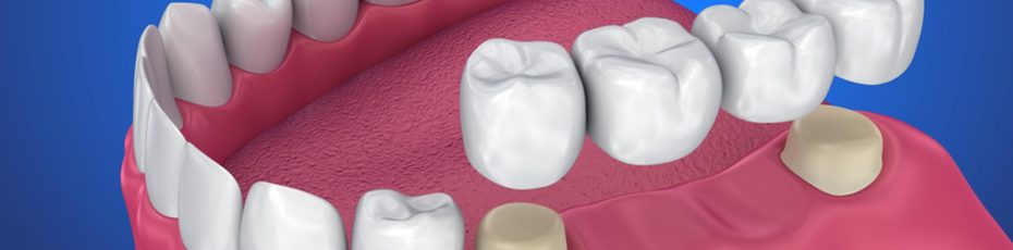 how to select the right dental bridge for you