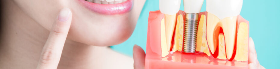 care guide for dental implants